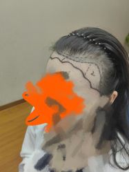 -大麦微针植发全国连锁