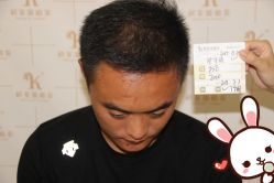 点击看大图 -大麦微针植发丨全国连锁