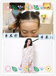 -大麦微针植发全国连锁