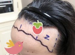 -大麦微针植发全国连锁