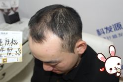 -大麦微针植发丨全国连锁