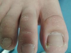 -祖传修脚甲沟炎灰指甲鸡眼
