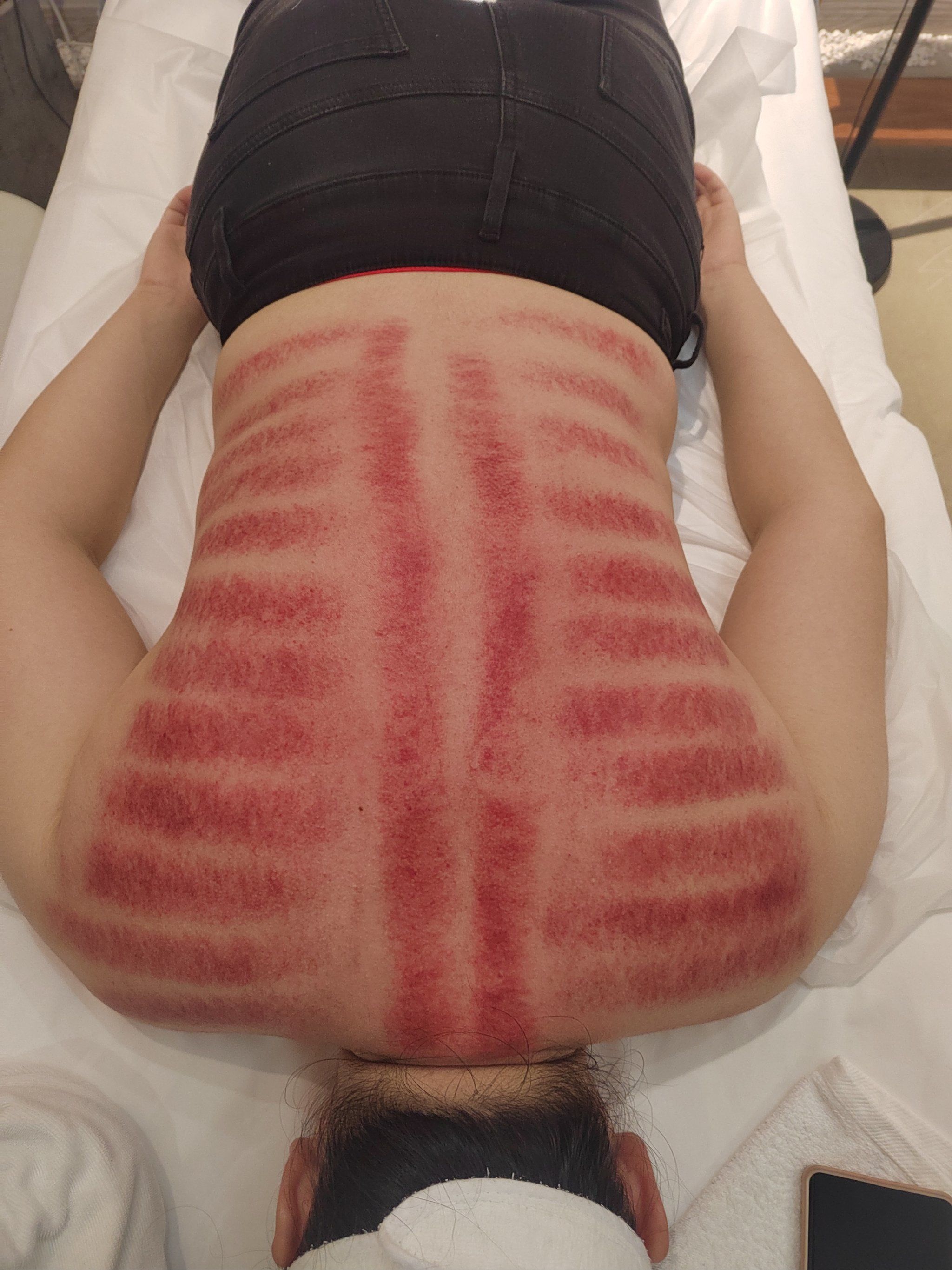 保持健康,从刮痧开始