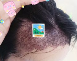 -大麦微针植发全国连锁