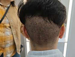 -大麦微针植发全国连锁