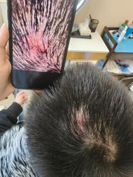 -碧莲盛·不剃发植发