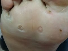 -祖传修脚甲沟炎灰指甲鸡眼