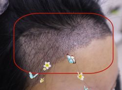 -大麦微针植发全国连锁