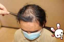 -大麦微针植发丨全国连锁