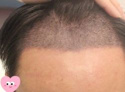 -大麦微针植发丨全国连锁