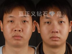 -北京米扬丽格医疗美容·联合丽格鼻整形中心