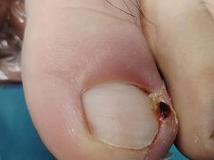 -祖传修脚甲沟炎灰指甲鸡眼