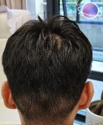 -大麦微针植发丨全国连锁