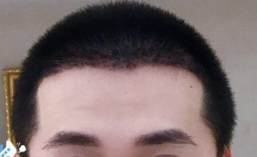 -大麦微针植发丨全国连锁