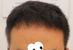 -大麦微针植发全国连锁