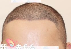 -大麦微针植发全国连锁