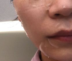 体验后-杭州星婉馨悦医疗美容