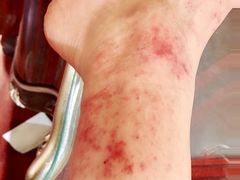 -大韩庄韩氏祖传正骨