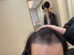 -碧莲盛·不剃发植发