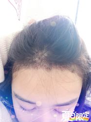 -大麦微针植发全国连锁