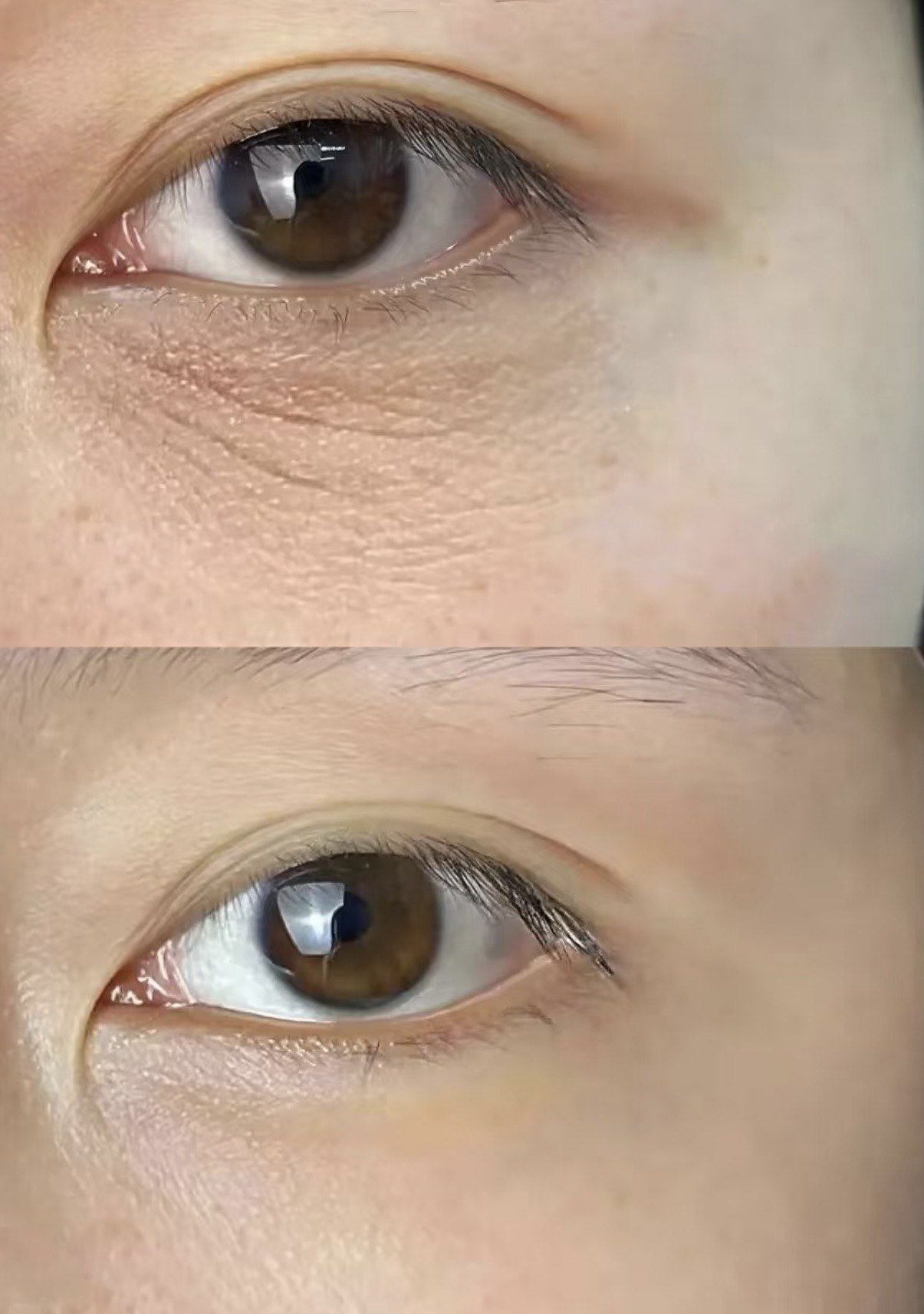 眼周皱纹解决方案