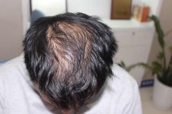 -大麦微针植发全国连锁