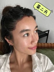 -碧莲盛·不剃发植发