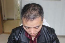 -大麦微针植发丨全国连锁