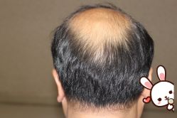 -大麦微针植发丨全国连锁