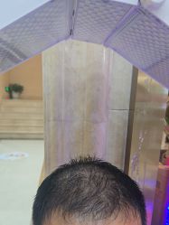 -碧莲盛·不剃发植发