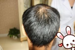 点击看大图 -大麦微针植发丨全国连锁