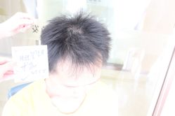 点击看大图 -大麦微针植发丨全国连锁