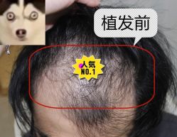 -大麦微针植发全国连锁