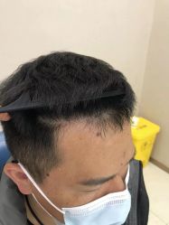 体验后-大麦微针植发丨全国连锁