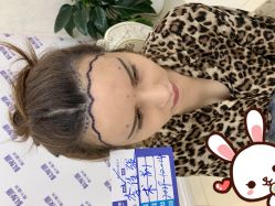 点击看大图 -大麦微针植发丨全国连锁