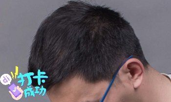 -大麦微针植发全国连锁