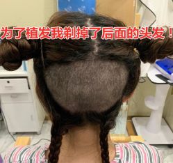 -碧莲盛·不剃发植发