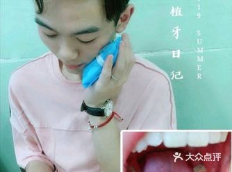还没戴牙冠，但已经迫不及待想跟大家分享了  