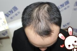 -大麦微针植发丨全国连锁