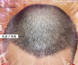 -大麦微针植发全国连锁