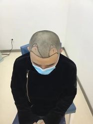 点击看大图 -大麦微针植发丨全国连锁