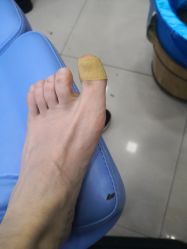 -德哥灰指甲脚气甲沟炎跖疣护理