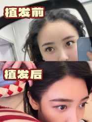 -碧莲盛·不剃发植发
