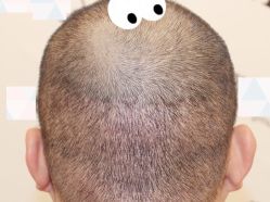 -大麦微针植发全国连锁