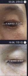 -爱莎扁平疣·汗管瘤·斑痣中心