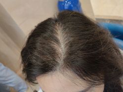 -碧莲盛·不剃发植发