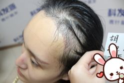 点击看大图 -大麦微针植发丨全国连锁