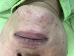 -苗医生草本科技祛痘