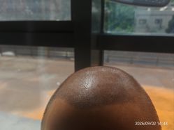 -碧莲盛·不剃发植发