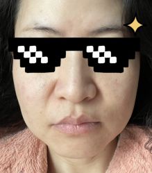 体验后-郡艺医疗美容·微整·眼鼻吸脂